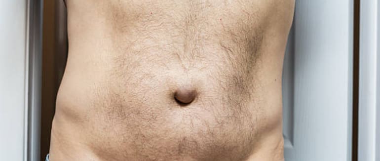 Cirugía de Hernia Abdominal